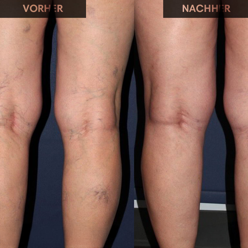 Bein und Venen Gel